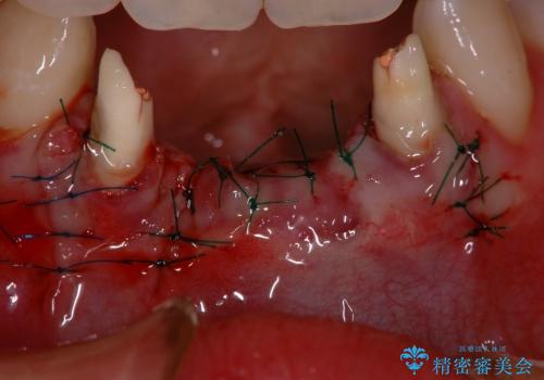 下顎前歯部の歯槽堤増大術　根面被覆　オールセラミック治療の治療中