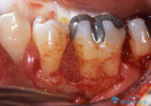 根分岐部病変と三壁性骨欠損部の歯周組織再生治療の治療中