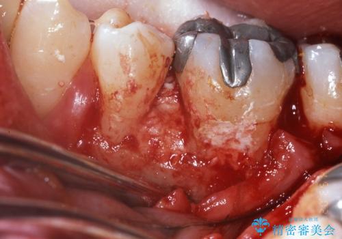 根分岐部病変と三壁性骨欠損部の歯周組織再生治療の治療中