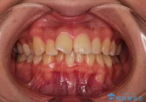 出っ歯・20代女性・裏側矯正・抜歯ケース・マイクロインプラント・2年の治療前