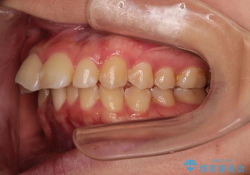 出っ歯・20代女性・裏側矯正・抜歯ケース・マイクロインプラント・2年の治療前