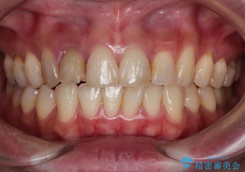 前歯のセラミックブリッジを綺麗に見せる、歯肉移植の治療前