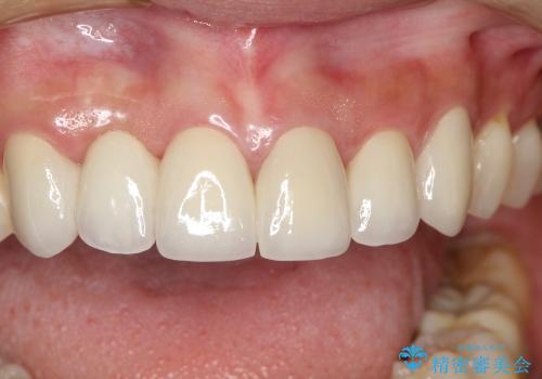 前歯のセラミックブリッジを綺麗に見せる、歯肉移植の治療後