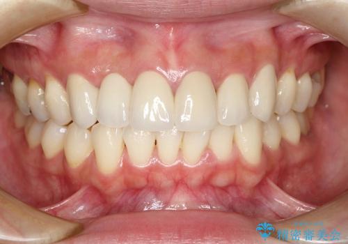 前歯のセラミックブリッジを綺麗に見せる、歯肉移植