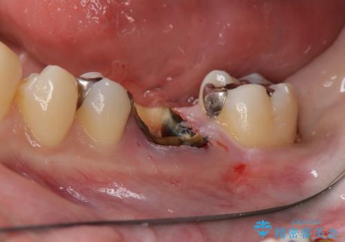 深い虫歯の歯を残す治療の治療前