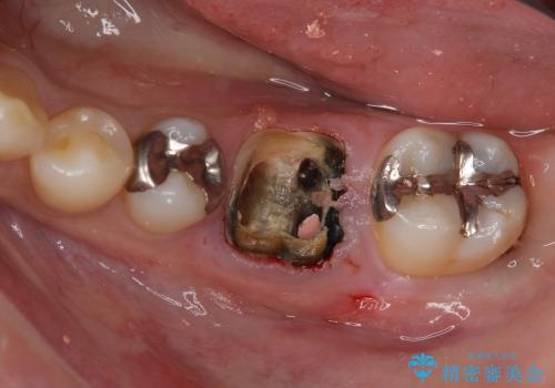 深い虫歯の歯を残す治療の治療前