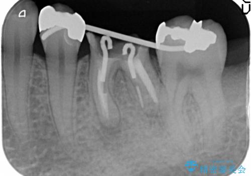 深い虫歯の歯を残す治療の治療中