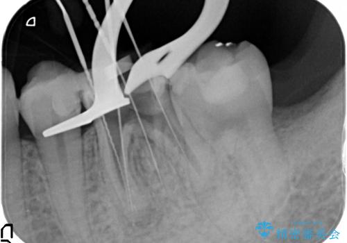 深い虫歯の歯を残す治療の治療中