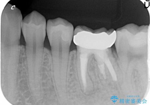 深い虫歯の歯を残す治療の治療後