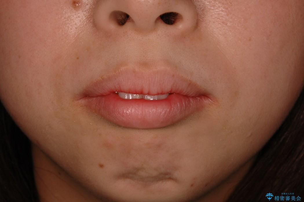 下あごがない　20代女性　ハーフリンガルの治療前（顔貌）