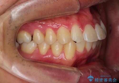 [30代男性] ガタガタが気になる 非抜歯で短期間の治療後