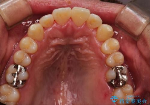 [30代男性] ガタガタが気になる 非抜歯で短期間の治療後