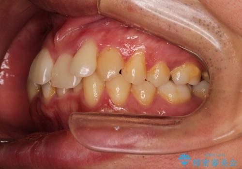 [30代男性] ガタガタが気になる 非抜歯で短期間の治療前