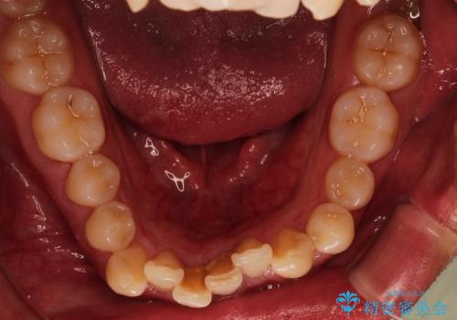 [30代男性] ガタガタが気になる 非抜歯で短期間の治療前