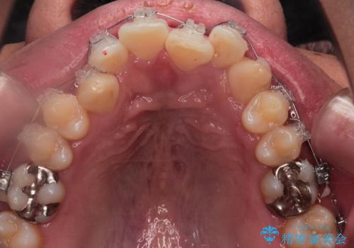 [30代男性] ガタガタが気になる 非抜歯で短期間の治療中
