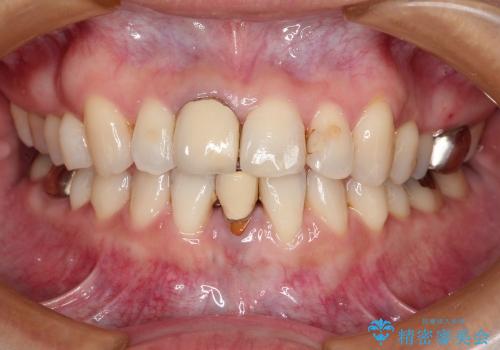 矯正歯科治療後の審美歯科(40代女性)の治療前