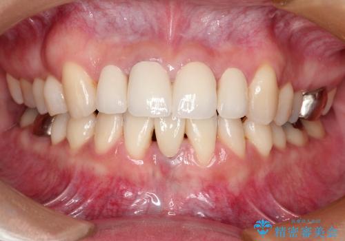 矯正歯科治療後の審美歯科(40代女性)の症例 治療後