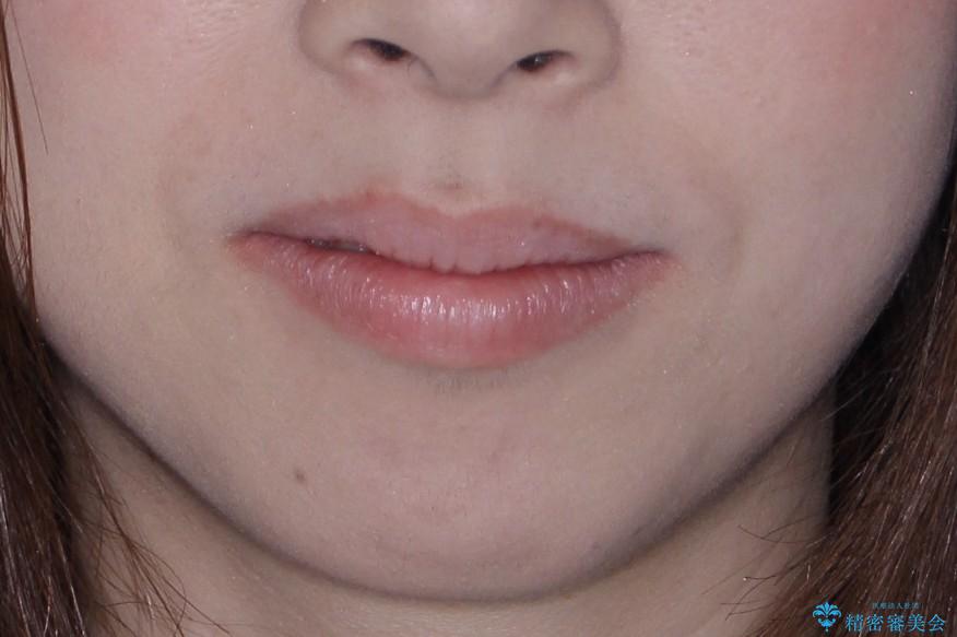 下あごがない　20代女性　ハーフリンガルの治療後（顔貌）