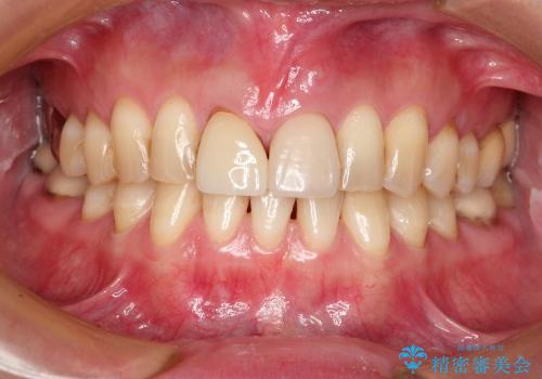 前歯のラミネートベニアをセラミッククラウンに(30代女性)の治療前