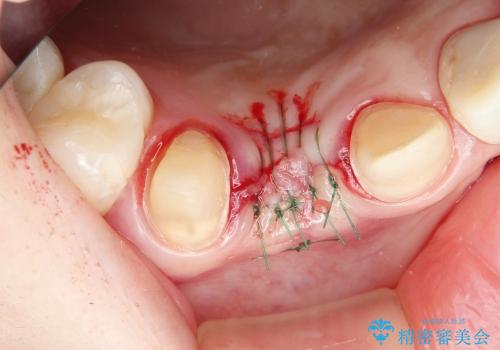 前歯のセラミックブリッジを綺麗に見せる、歯肉移植の治療中