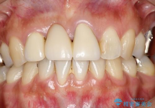 歯ぐきの黒ずみを治す前歯のブリッジ治療の治療前