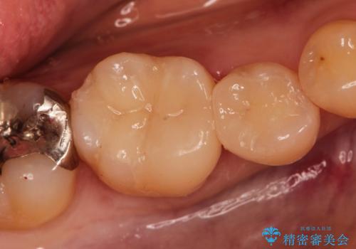 銀歯の下に再発した虫歯の審美的セラミック治療の症例 治療後