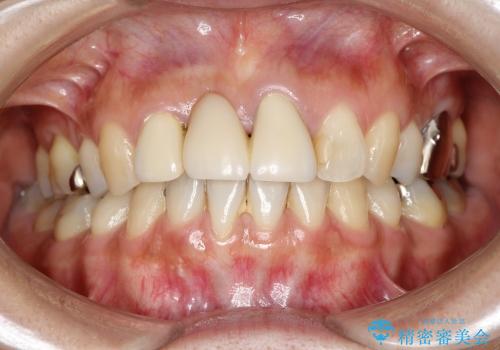 歯ぐきの黒ずみを治す前歯のブリッジ治療の治療前