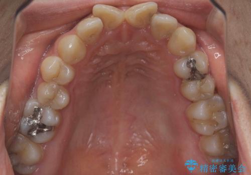 前歯のねじれ　歯を抜かない矯正治療の治療前