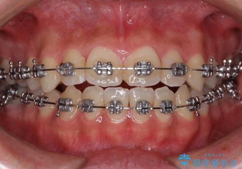 前歯のねじれ　歯を抜かない矯正治療の治療中