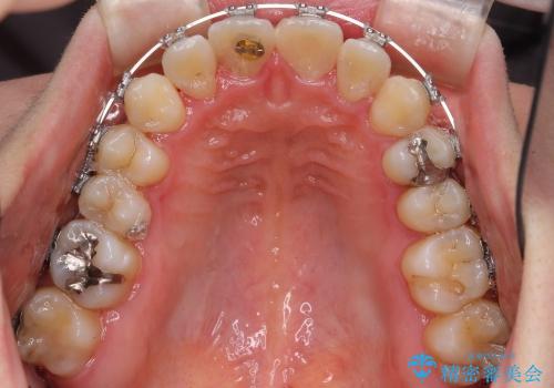 前歯のねじれ　歯を抜かない矯正治療の治療中