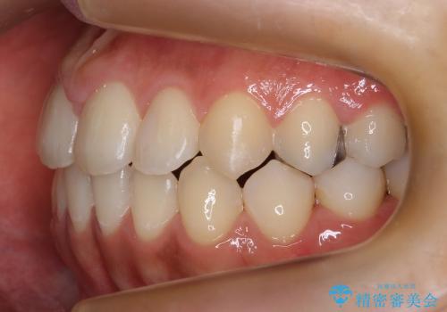前歯のねじれ　歯を抜かない矯正治療の治療後