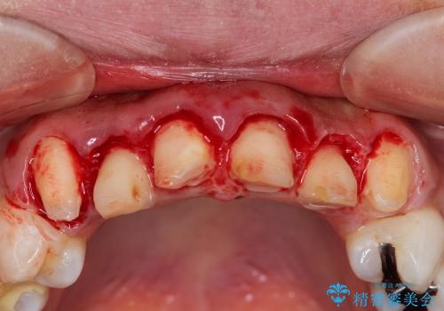 歯ぐきの状態を改善した上顎前歯セラミック治療の治療中