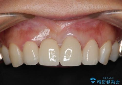 歯ぐきの黒ずみを治す前歯のブリッジ治療