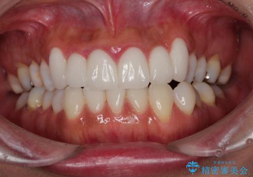 歯ぐきの状態を改善した上顎前歯セラミック治療の症例 治療前