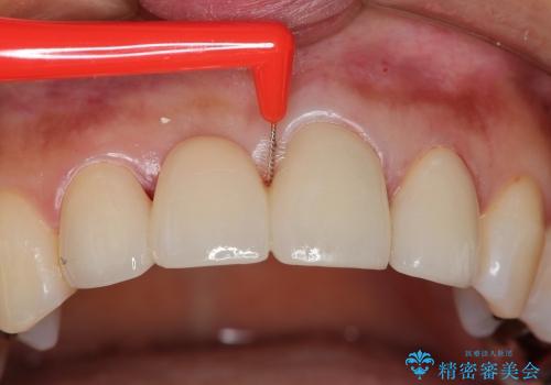 歯ぐきの黒ずみを治す前歯のブリッジ治療の治療中