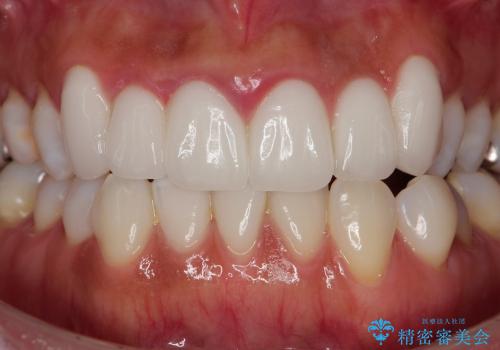 歯ぐきの状態を改善した上顎前歯セラミック治療の治療前
