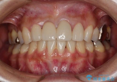 歯ぐきの黒ずみを治す前歯のブリッジ治療の症例 治療後