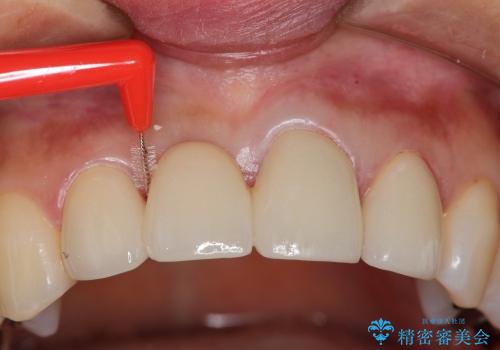 歯ぐきの黒ずみを治す前歯のブリッジ治療の治療中