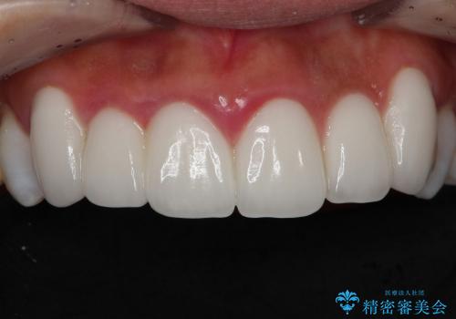 歯ぐきの状態を改善した上顎前歯セラミック治療の治療前