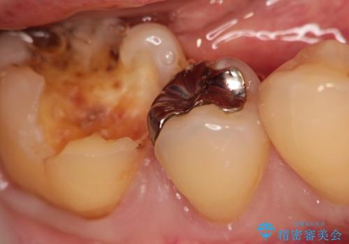 銀歯の下に再発した虫歯の審美的セラミック治療の治療前