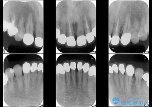 総合歯科診療(着色歯と歯並びの改善)の治療後