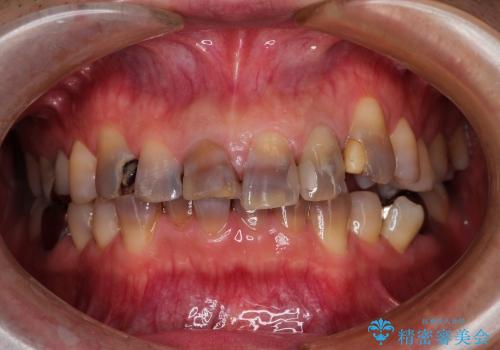総合歯科診療(着色歯と歯並びの改善)