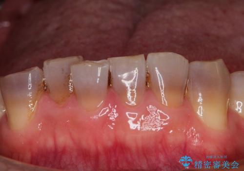 総合歯科診療(着色歯と歯並びの改善)の治療前