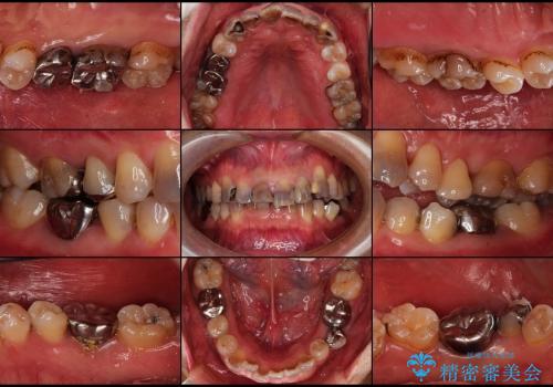 総合歯科診療(着色歯と歯並びの改善)の症例 治療前