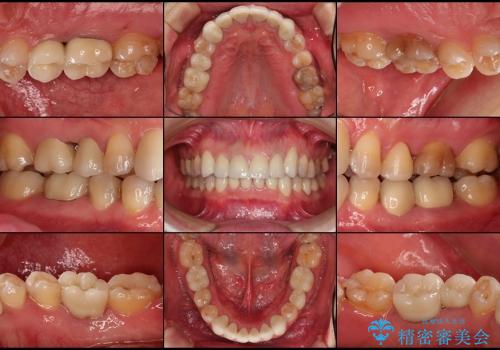 総合歯科診療(着色歯と歯並びの改善)の症例 治療後