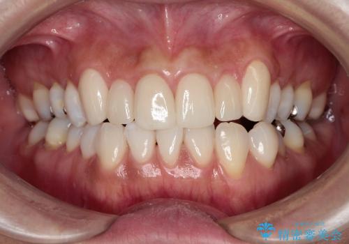 歯ぐきの状態を改善した上顎前歯セラミック治療の症例 治療後