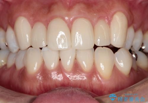 歯ぐきの状態を改善した上顎前歯セラミック治療の治療後