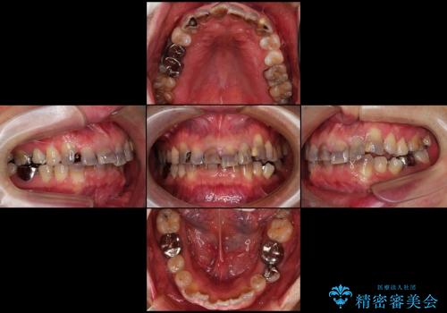 総合歯科診療(着色歯と歯並びの改善)の治療前