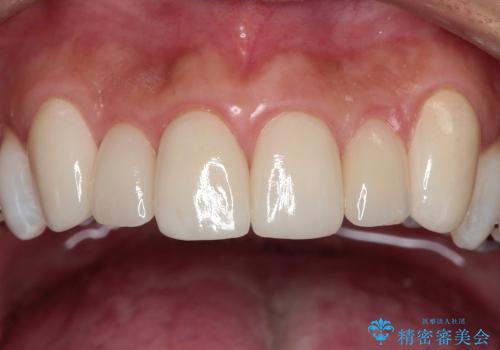 歯ぐきの状態を改善した上顎前歯セラミック治療の治療後