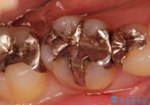 銀歯の下に再発した虫歯の審美的セラミック治療の症例 治療前